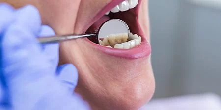 Cómo afecta el tabaco a la salud bucodental